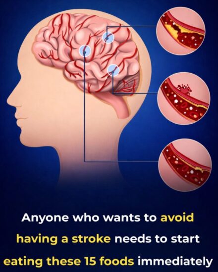 Anyone who wants to prevent a stroke needs to start eating these 15 foods immediately